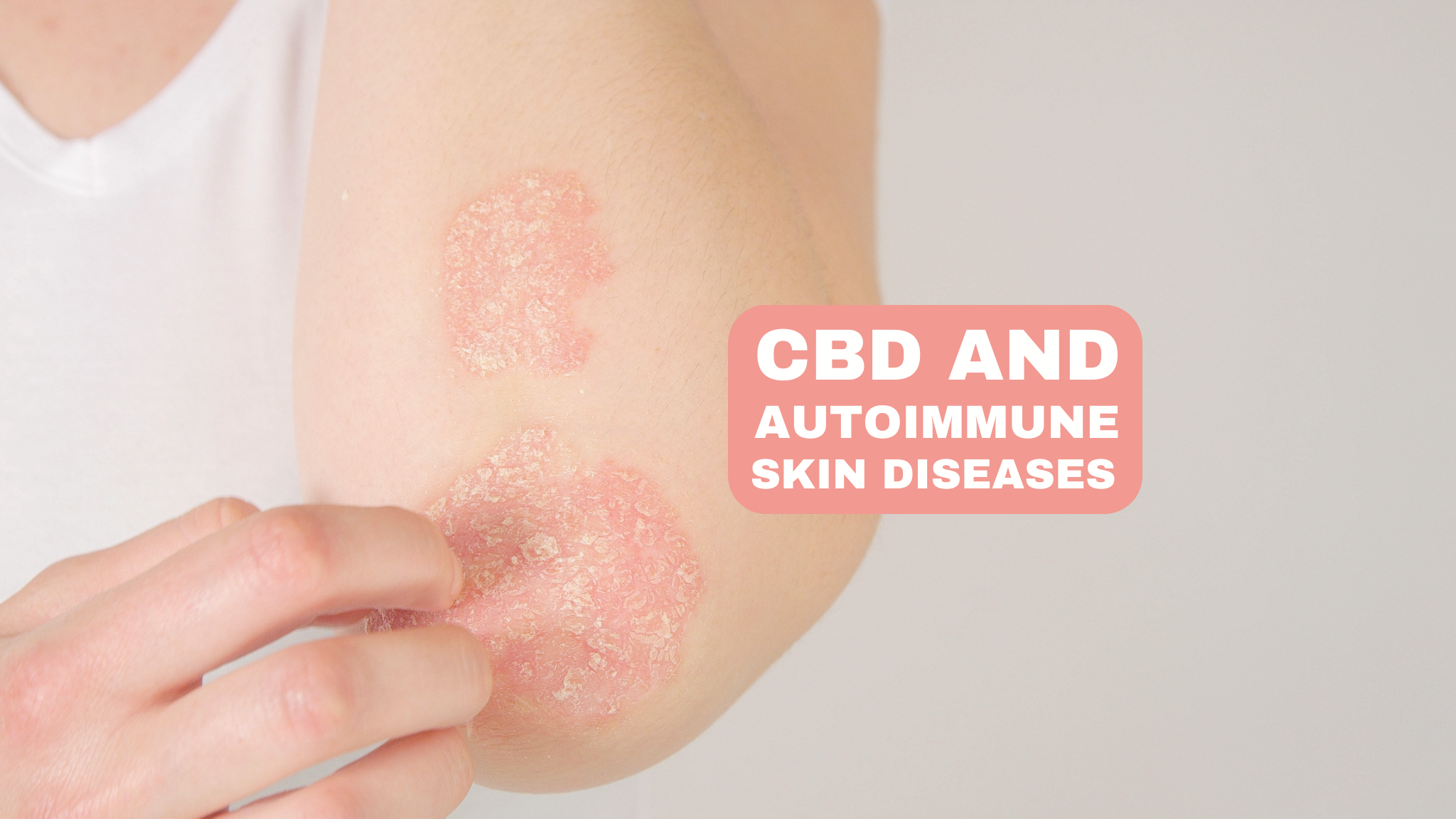 CBD a autoimunitné kožné poruchy: Vplyv CBD na autoimunitné kožné poruchy, ako je psoriáza a ekzém